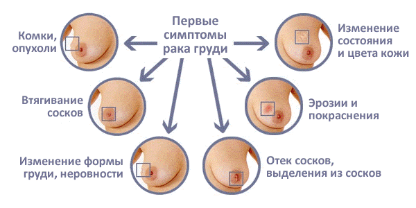 Инфографика: Первые симптомы рака груди